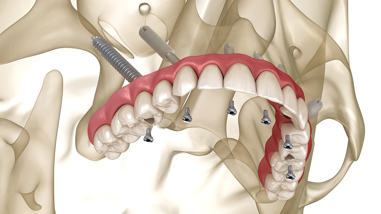 Ilustracja medyczna implantów zygomatycznych osadzonych w kości jarzmowej